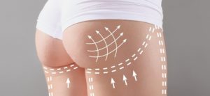 le Brazilian Butt Lift