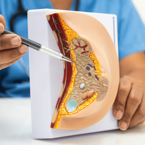 Augmentation Mammaire Réussie par Lipofilling