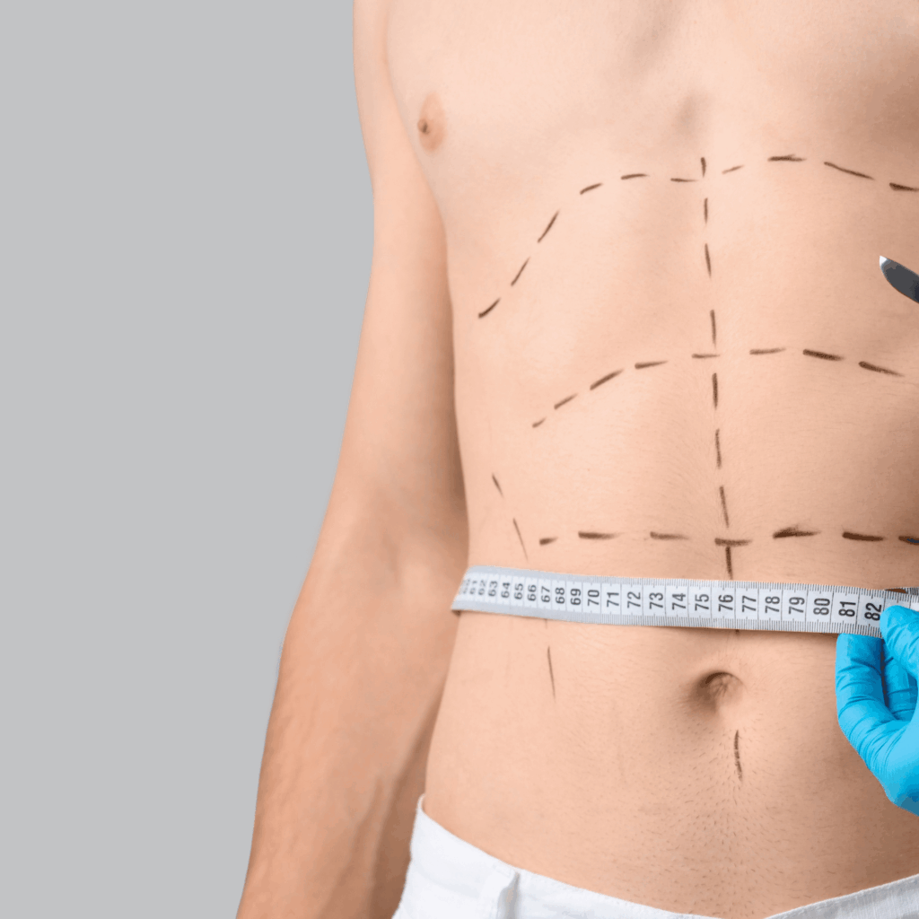 Abdominoplastie : transformation complète du ventre