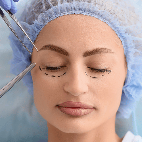 Blépharoplastie inférieure : solution contre les poches sous les yeux
