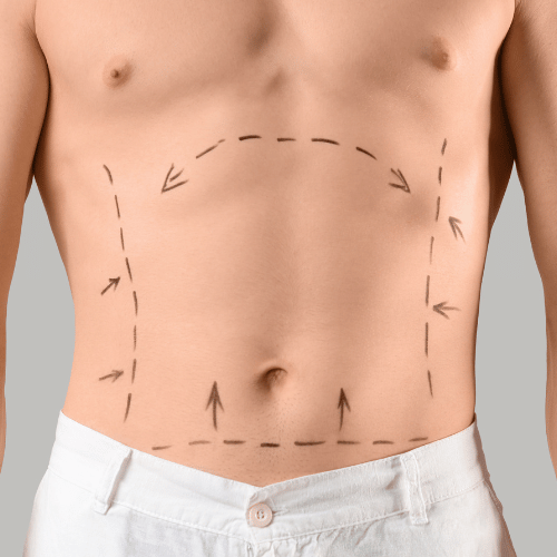 Mini abdominoplastie : pour quels cas est-elle suffisante ?
