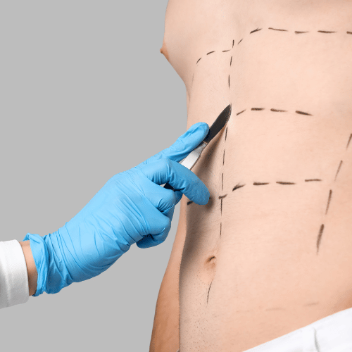 Sculpture abdominale : définition des abdos par liposuccion HD