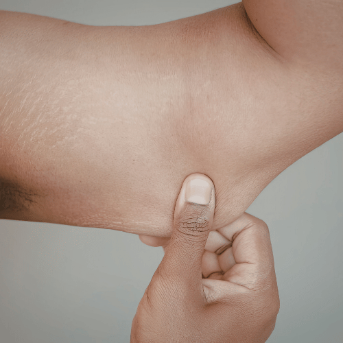 Liposuccion des bras : éliminer les amas graisseux résistants